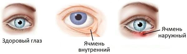 Ячмень на глазу может быть наружный и внутренний