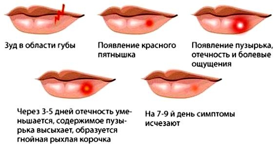 Процесс протекания герпеса на губах 