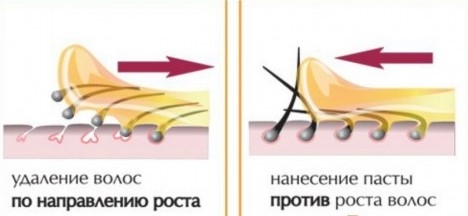 Схема удаления волос
